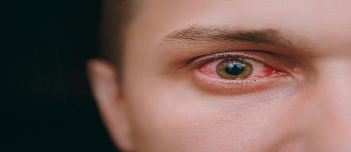 Dry eyes and prolonged screen use